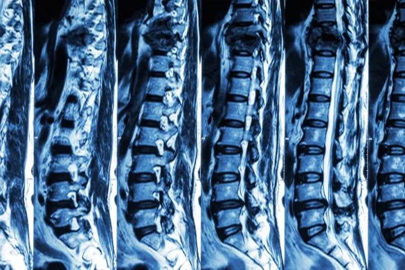 Montana Spinal Cord Injury Lawyer